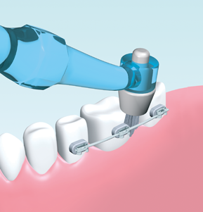 I-Prox P - Brackets