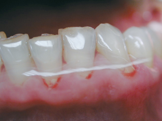 Miradont Gel