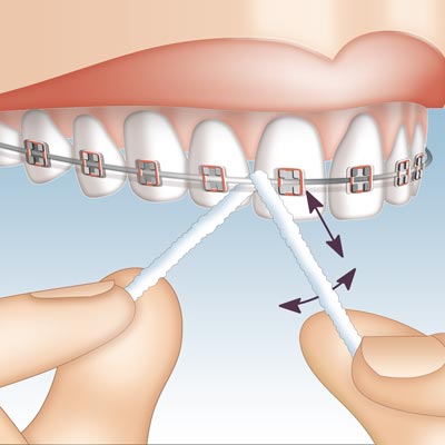 Mirafloss Implant CHX Anwendung 2