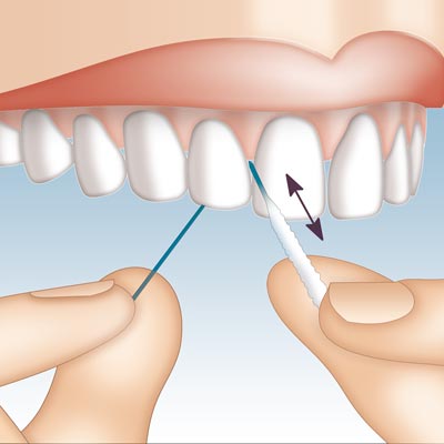 Mirafloss Implant CHX Anwendung 1